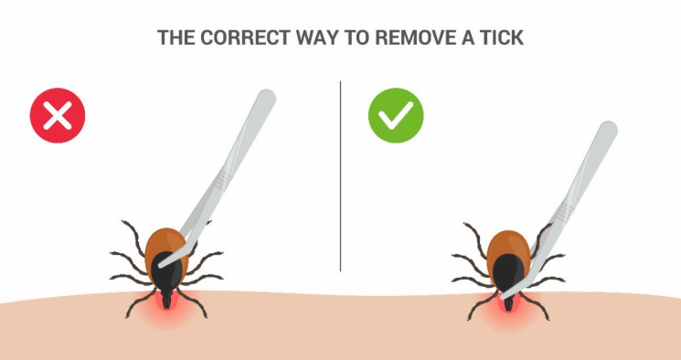 The correct way to remove a tick.